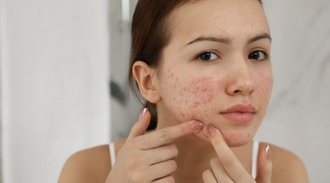 Your Ultimate Skincare Guide for Sensitive Acne-Prone Skin – THERAPYSKIN